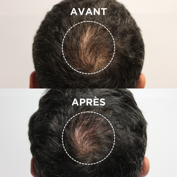 Lazartigue – Thicker Hair Serum (Sérum Anti-Chute Densifiant), vue de dessus des cheveux d'un homme avant et après traitement